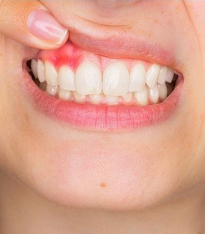Parodontologie la Clinica Dentipo București